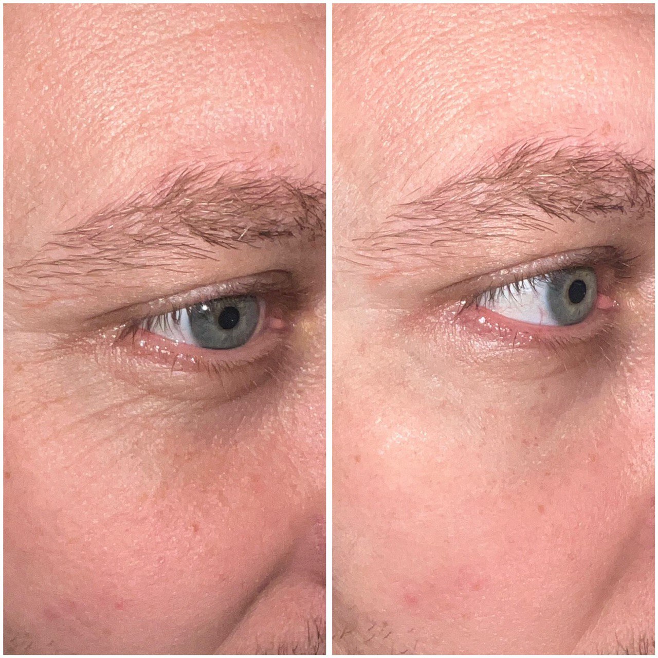 Contour des yeux anti-rides « shock action » avec ALPHASYN™