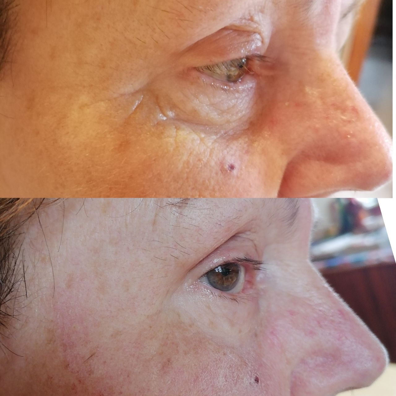 Contour des yeux anti-rides « shock action » avec ALPHASYN™