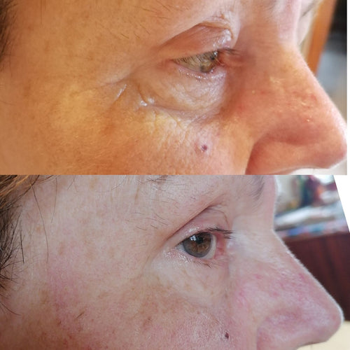 Contour des yeux anti-rides « shock action » avec ALPHASYN™